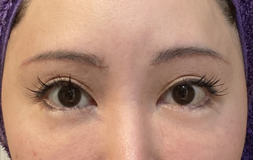 症例写真 術後 眉下切開法
