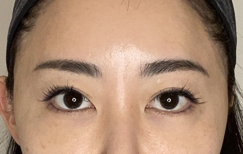 症例写真 術前 眉下切開法