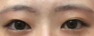 症例写真 術後 眉下切開法