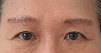 症例写真 術後 眉下切開法