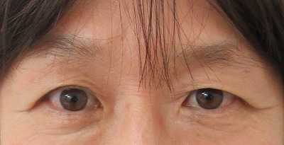 症例写真 術前 眉下切開法