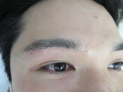 症例写真 術後 眉下切開法