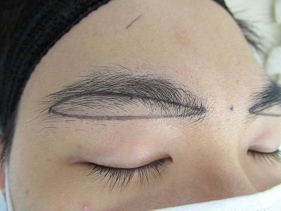 症例写真 術前 眉下切開法