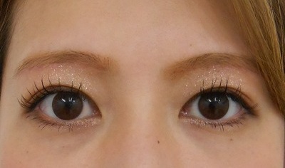 症例写真 術後 眉下切開法