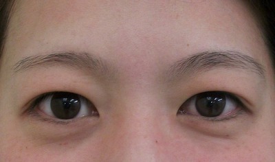 症例写真 術前 眉下切開法