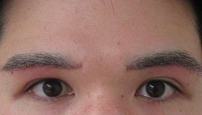 症例写真 術後 眉下切開法