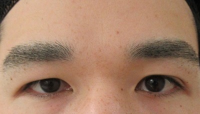 症例写真 術前 眉下切開法