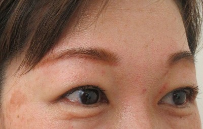 症例写真 術後 眉下切開法