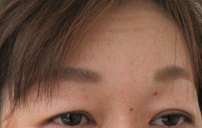 症例写真 術前 眉下切開法