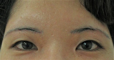 症例写真 術後 眉下切開法