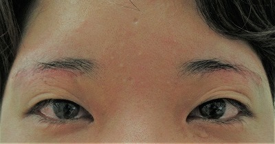症例写真 術前 眉下切開法