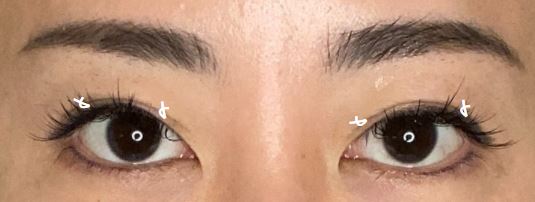 二重埋没法画像